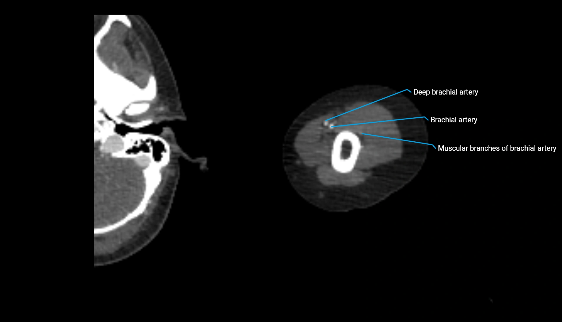 CTA upper limb axial cross sectional anatomy labelled image 265 (2).webp